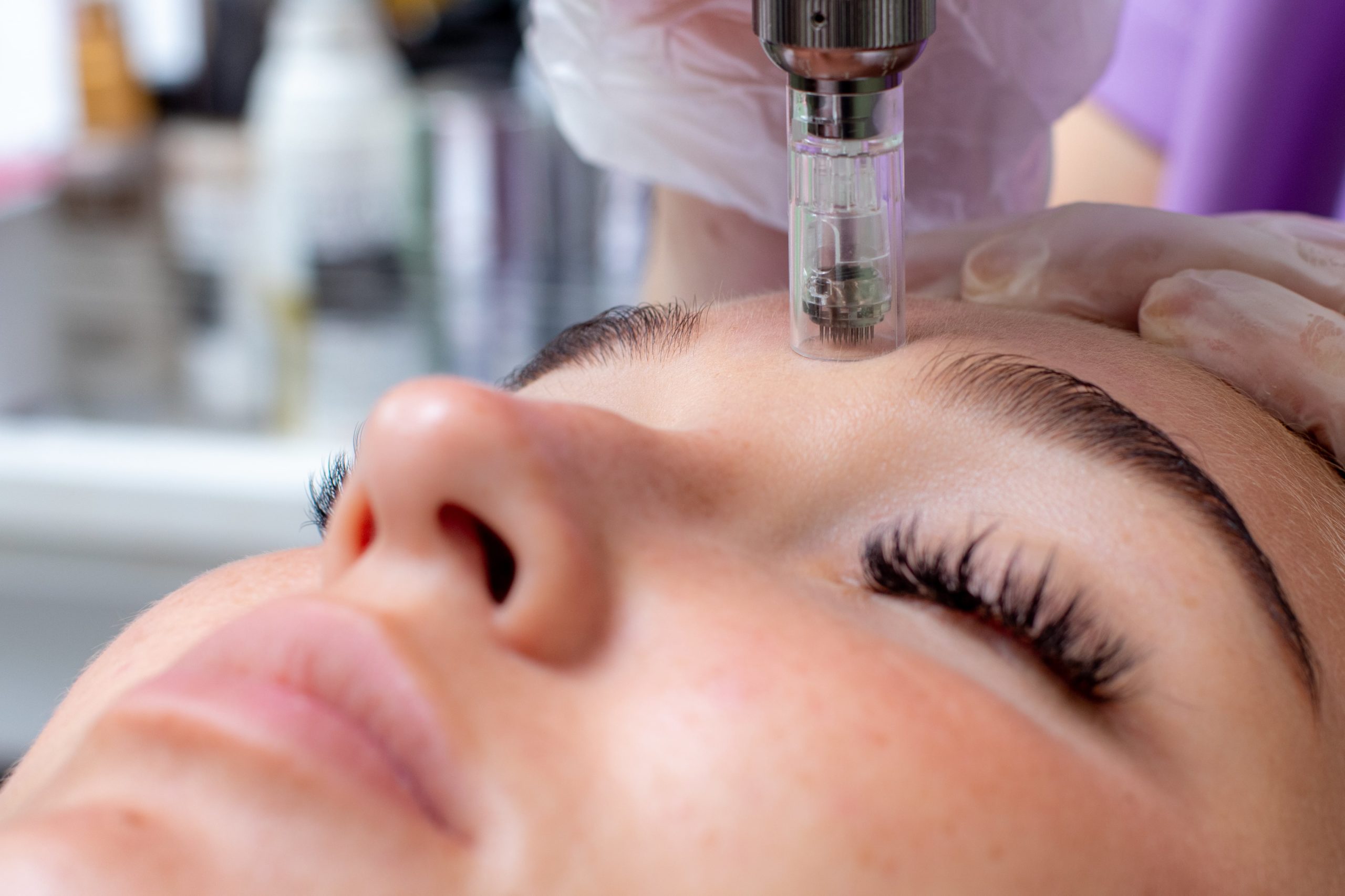 Microneedling Treatment