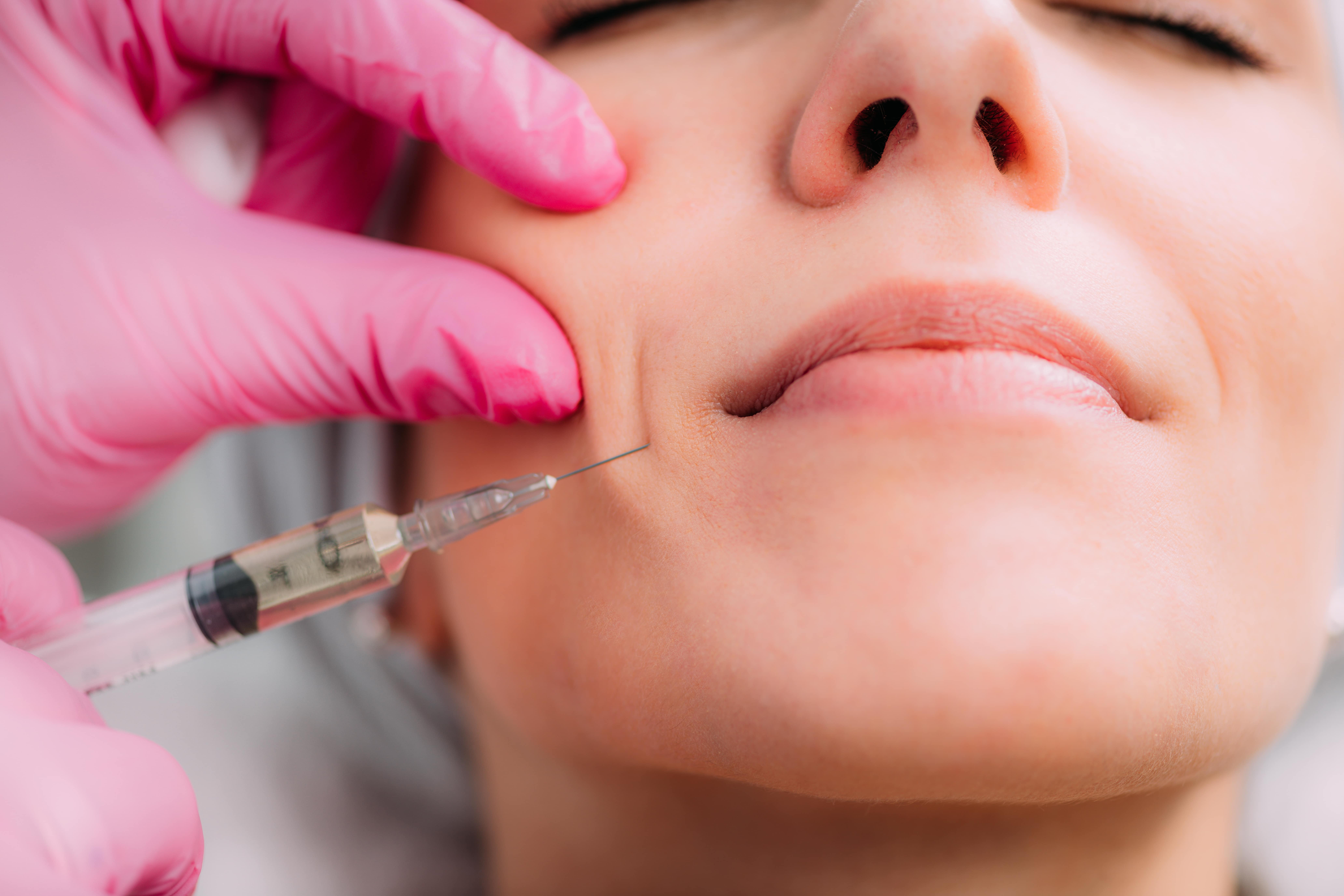 Filler Treatment by Bare Skin and Wellness